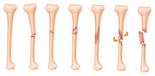 Diagram Of Leg Fracture In Different Stages
