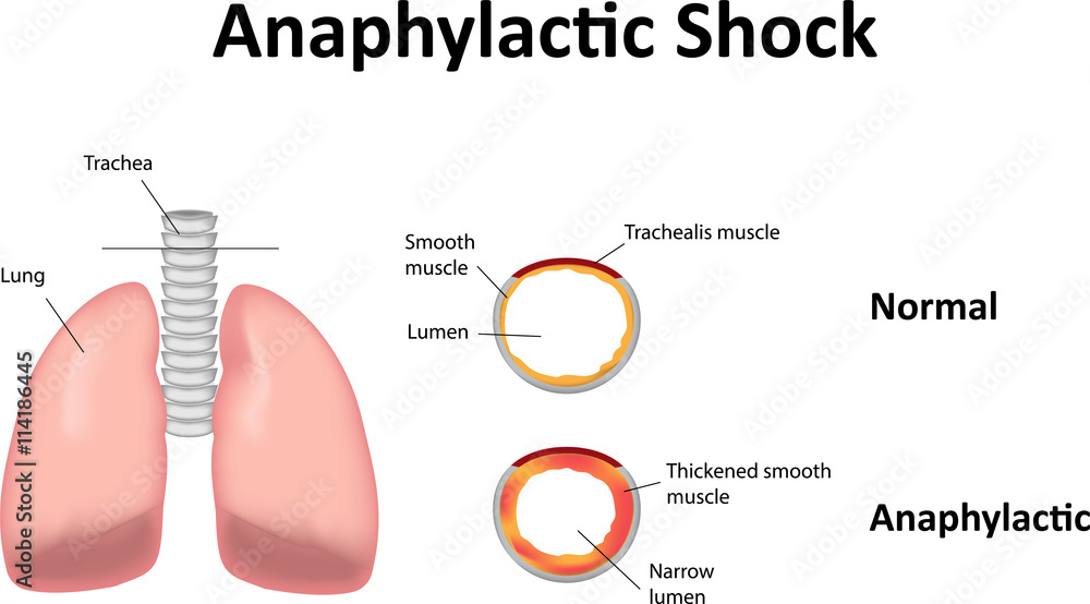 Anaphylactic Shock Stock Illustration | Adobe Stock