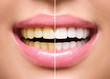 © Subbotina Anna - Woman teeth before and after whitening. Oral care