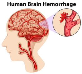 Canvas Print - Diagram of human brain hemorrhage