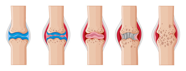 Canvas Print - Rheumatoid arthritis in human joints