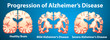Progression of Alzheimer's disease on blue background