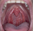 open throat tonsil