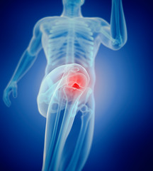 3d rendered medically accurate illustration of a painful knee