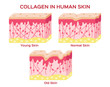 collagen in younger skin and aging skin , 3 type collagen skin version