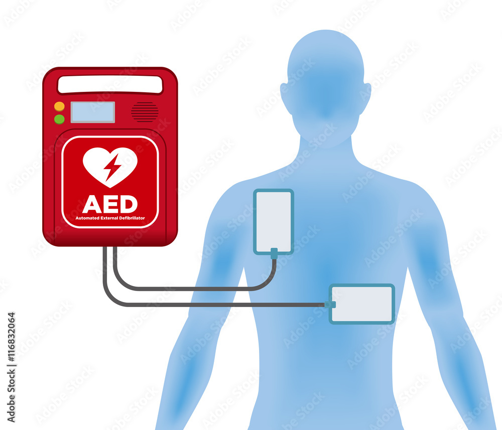 AED(Automated External Defibrillator) and human body, main machine and electrode pads - obrazy, fototapety, plakaty 