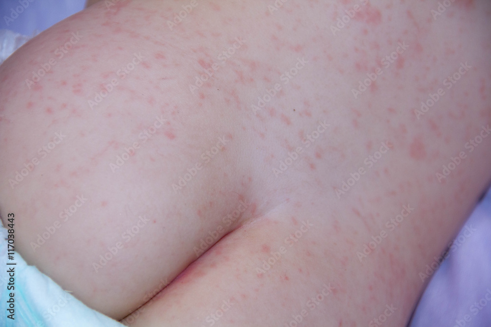 baby with dermatitis problem of rash. Allergy rash suffering from food ...