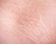 Stretch marks of skin on the thigh