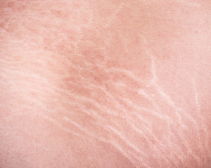 stretch marks of skin on the thigh