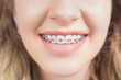© Sondem - Smiling Woman with Teeth braces