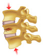 vertebral compression fracture