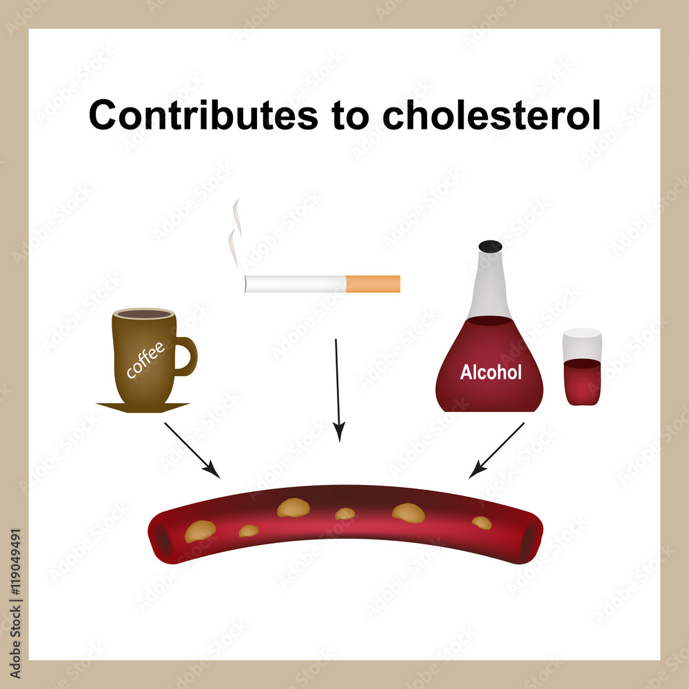 Coffee, cigarettes and alcohol raise cholesterol levels in the blood.  Cholesterol plaques. Infographics. Vector illustration Stock Vector