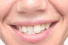 Woman Crooked Teeth