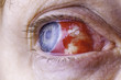 © Ian Dyball - Close up shot of a bloodshot eye