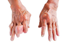 Hands Of Gout Patient