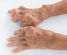 Fingers Of Patient With Gout.