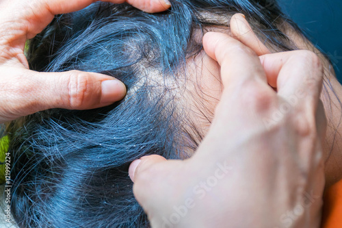 Lice: Pictures, Symptoms, FAQs