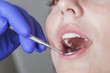 canvas print picture - Nahaufnahme Mund mit Spiegel beim Zahnarzt mit Gummihandschuhe