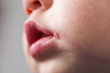 herpes on the mouth of the child