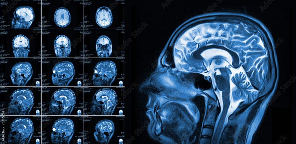 Magnetic resonance imaging of the brain Stock Photo | Adobe Stock