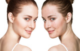Fototapeta Panele - Girl with acne before and after treatment