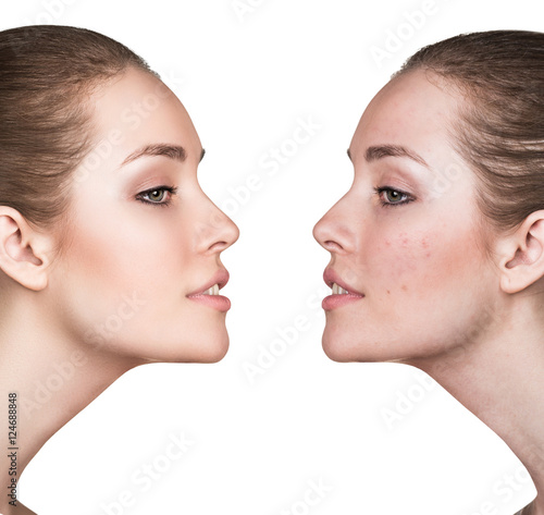 Poster Girl with acne before and after treatment