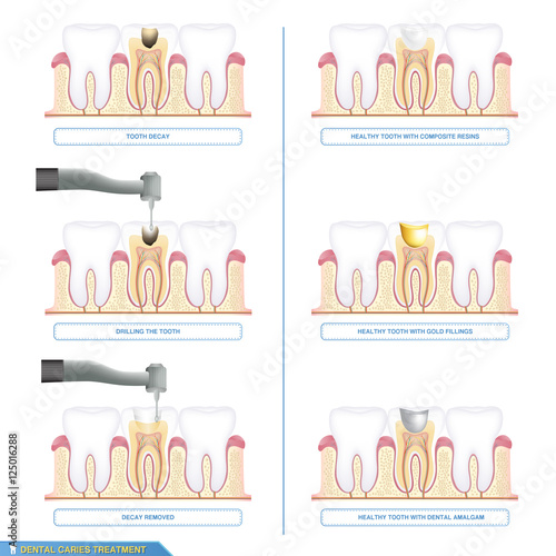 Fotografija Infographics dental caries treatment and the different types of tooth fillings,