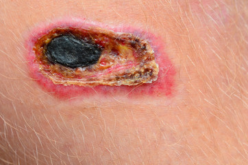 A necrotic scab on a human leg