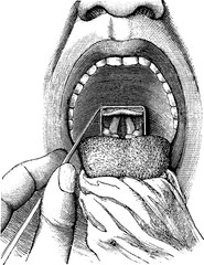 Wall Mural - laryngoscopy, vintage engraving