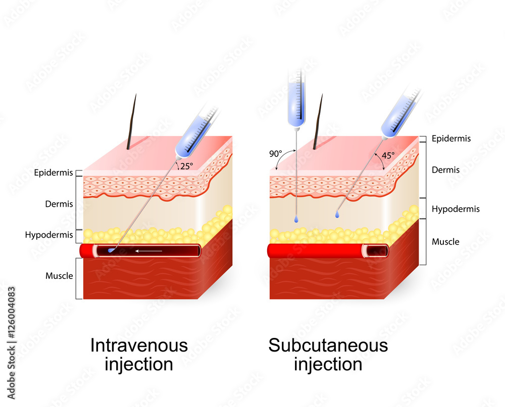 Intravenous therapy and Subcutaneous injection. Stock Vector | Adobe Stock