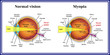 Refractive errors eyeball. Myopia.