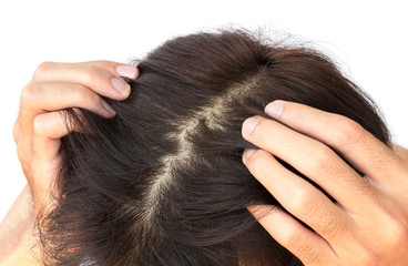 Young man serious hair loss problem for hair loss concept