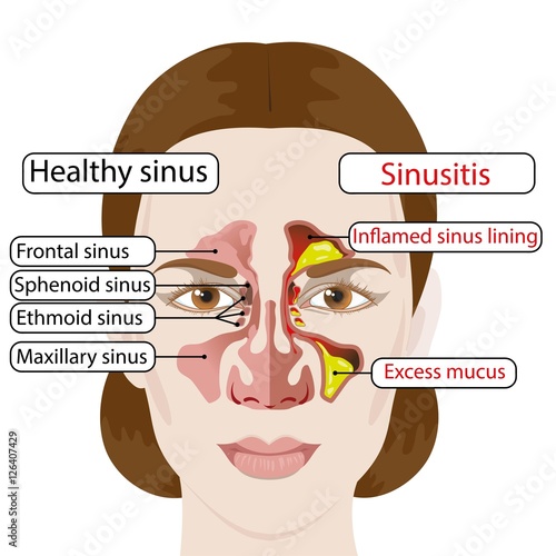 Sinusitis. Healthy and inflamed sinuses. Medical poster Buy this