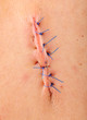 © uwimages - Seven non absorbable sutures in a person's upper back.