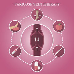 Wall Mural - Infographics phlebology, treating varicose veins on women's legs. Varicose vein icons.