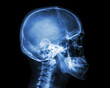 © stockdevil - Film x-ray skull and cervical spine lateral view