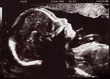 Ultrasound of In Uterus Baby at 22 weeks. Healthy baby in belly.
