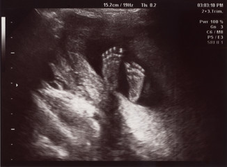 ultrasound of in uterus baby at 22 weeks. healthy baby in belly.