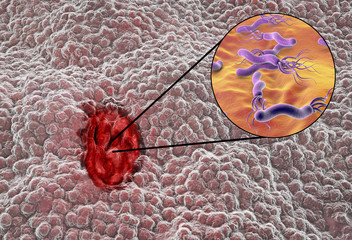 Poster - Gastric ulcer. Mucosa of stomach with peptic ulcer and close-up view of bacterium Helicobacter pylori which causes ulcers. 3D illustration