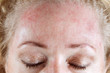 Mature woman's very dry & peeling skin with seborrheic dermatitis