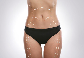 Poster - Young female body with marks for plastic operation, gray background. Liposuction concept