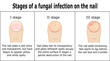 © scio21 - Three stages of development of fungal infection on nail of the toe
