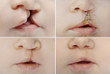 Close up on the lips of baby before and after lip and palate cleft  surgery.