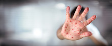 HFMD - Hand Foot And Mouth Disease - Viral Diseases With Hand Infected
