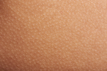 Wall Mural - goose bumps on human skin