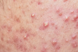 Fototapeta Do akwarium - Acne on facial skin,Dermatological disease acne