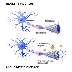 Wall Mural - healthy cell and neurons with Alzheimer's disease. Tau hypothesis