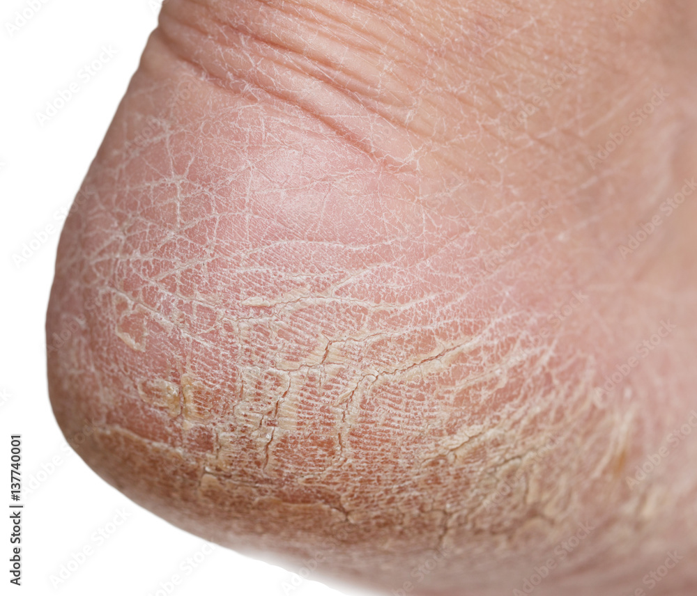 dry skin on the legs with cracks Stock Photo Adobe Stock