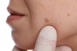 © dream@do - Doctor dermatologist examines birthmark of patient close up islolated on white background. Checking benign moles. Laser Skin tags removal