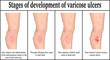 Stages of development of varicose ulcers